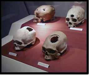 Four Inca trepanation skulls